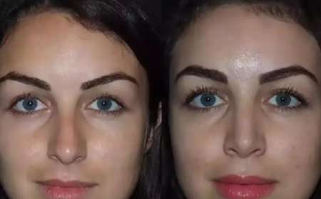How Rhinoplasty in Dubai Can Enhance Your Facial Harmony