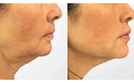 Thread Lift Treatments in Dubai: The Ultimate Solution for Non-Invasive Skin Lifting
