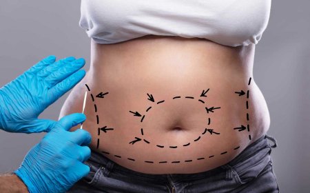 Tummy Tuck  What Are the Key Differences Between a Full Tummy Tuck and Mini Tummy Tuck