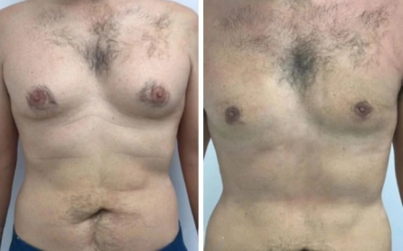 5 Reasons to Choose the Best Gynecomastia Surgeon in dubai for Your Surgery