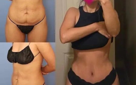 How to Achieve a Flatter Stomach with the Best Tummy Tuck Surgeon in dubai