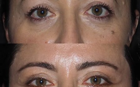 What Makes a Surgeon the Best Eye bag removal Surgeons in Dubai?