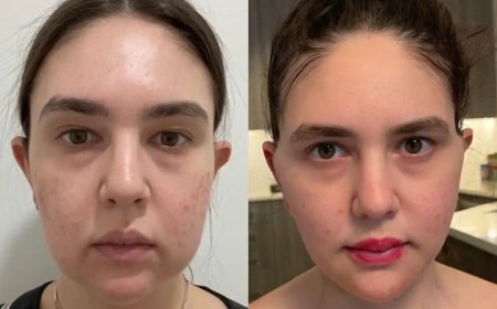 The Artistic Eye of the Best Buccal fat removal Surgeons in Dubai