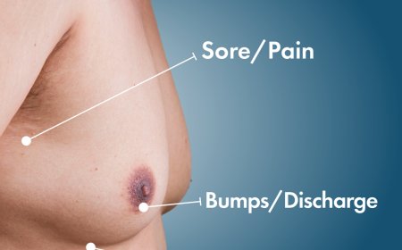 What You Should Know About Gynecomastia in Islamabad Before Surgery