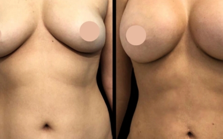 Why Breast Augmentation in Dubai Is in High Demand