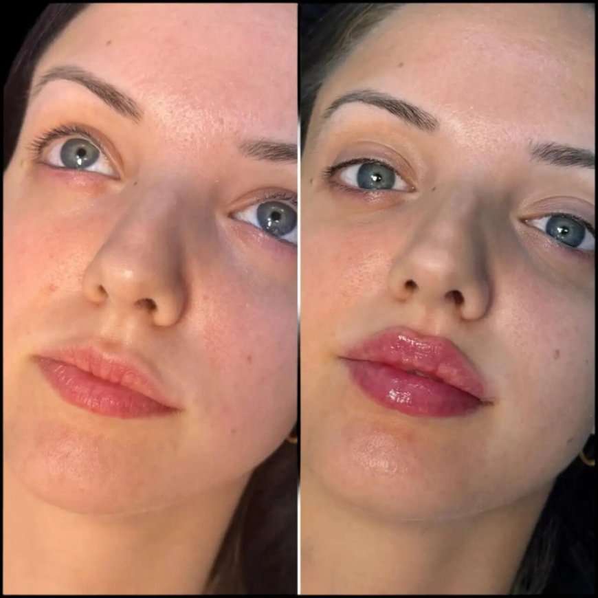 Why the Best Doctors in dubai for Fillers Are Known for Their Expertise