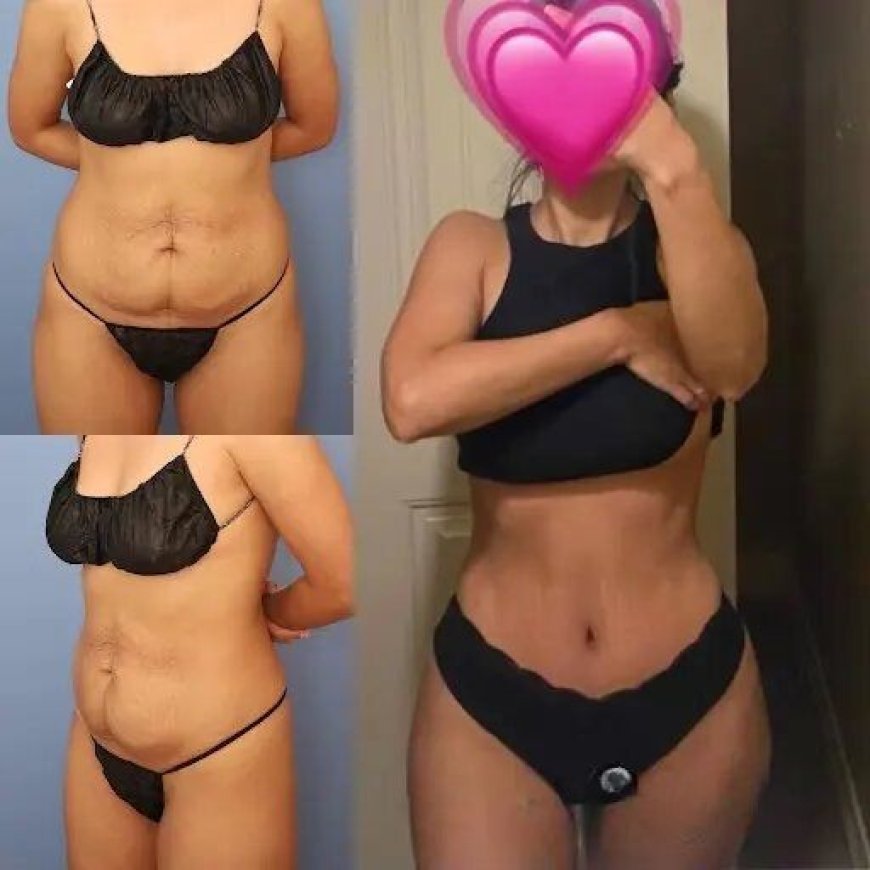 How to Achieve a Flatter Stomach with the Best Tummy Tuck Surgeon in dubai