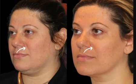 Sculptra Fillers at Best Aesthetic Clinics in Dubai: Collagen Timeline