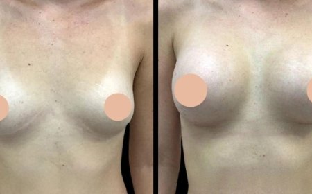 How to Prepare for Your Consultation with the Best Breast Augmentation Surgeons in Dubai